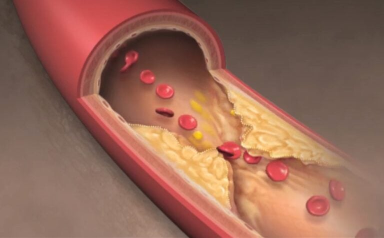 Atherosclerosis