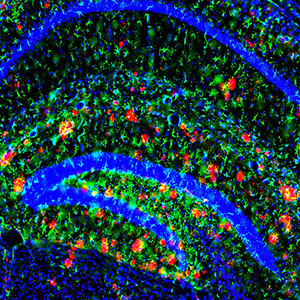 Amyloid beta plaque. Image by John Cirrito Amyloid beta plaque.