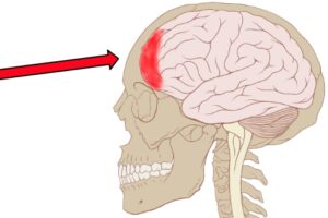 Head concussion