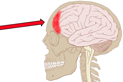 Head concussion