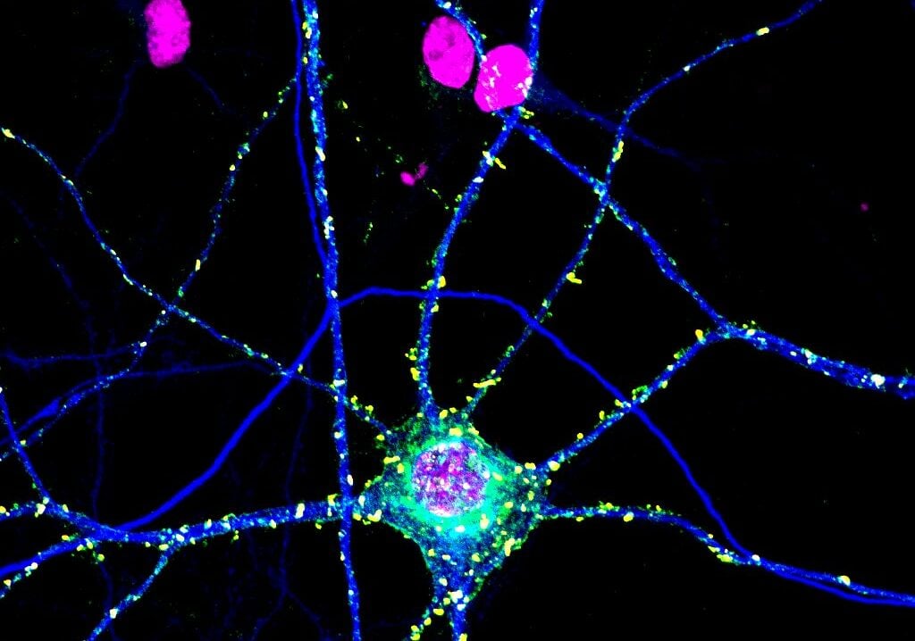 Neurons signaling in an Alzheimer's brain