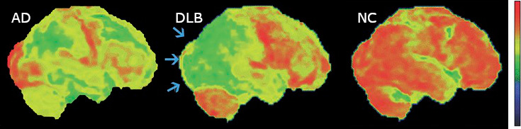 Scans of brains with Alzheimer's and Lewy Body Dementia
