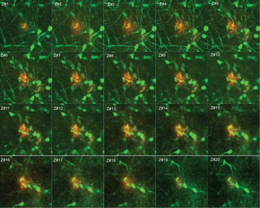 Brain cells growing in 3-D in a dish harbor genes for familial Alzheimer's disease. Brain cells growing in 3-D in a dish harbor genes for familial Alzheimer's disease.