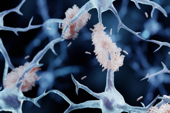 Alzheimer's Amyloid Plaques choking neurons
