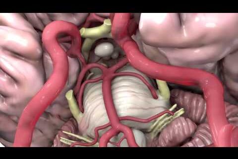 Vascular Dementia Animation