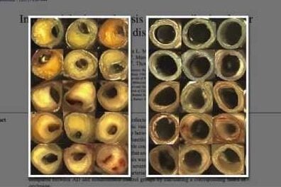 Artherosclerosis in two different person's arteries